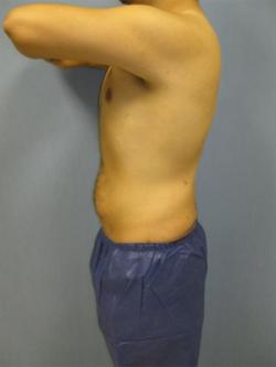 After Results for Gynecomastia