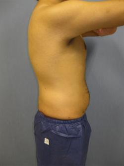 After Results for Gynecomastia