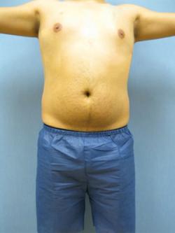 Before Results for Liposuction, Gynecomastia