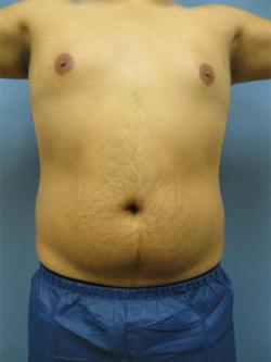 Before Results for Liposuction, Gynecomastia