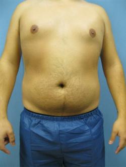 Before Results for Gynecomastia