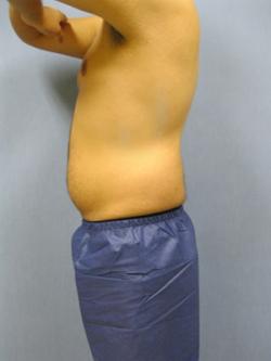 Before Results for Gynecomastia