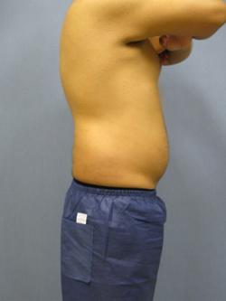 Before Results for Gynecomastia