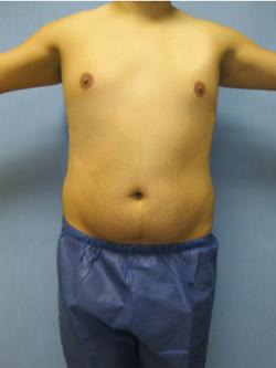 Before Results for Gynecomastia
