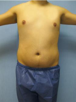 Before Results for Liposuction