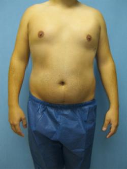 Before Results for Liposuction