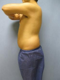 Before Results for Liposuction