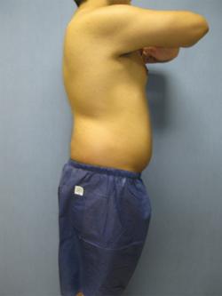 Before Results for Liposuction