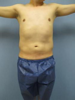 After Results for Gynecomastia