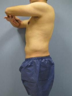 After Results for Liposuction