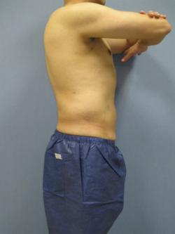 After Results for Liposuction