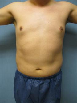 Before Results for Liposuction, Gynecomastia