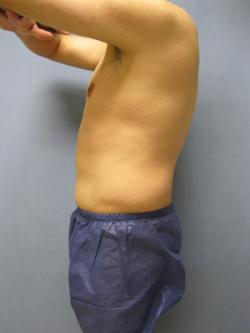 Before Results for Liposuction