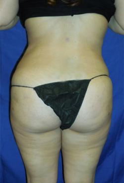 After Results for Liposuction, Gluteal Augmentation