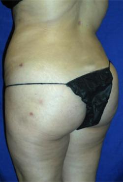 After Results for Liposuction