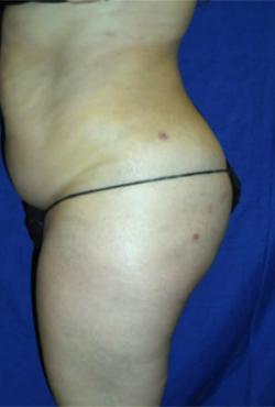 After Results for Gluteal Augmentation