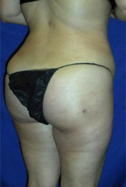 After Results for Gluteal Augmentation