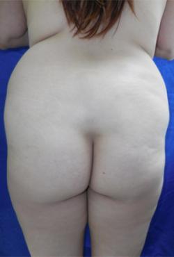 Before Results for Gluteal Augmentation