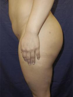 After Results for Gluteal Augmentation