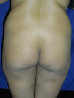 Before Results for Brazilian Butt Lift / Gluteal Augmentation