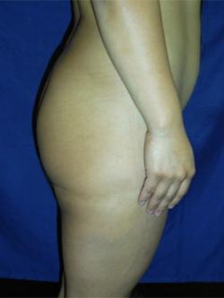 Before Results for Gluteal Augmentation