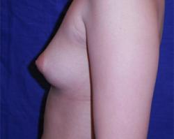 Before Results for Breast Augmentation