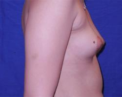 Before Results for Breast Augmentation