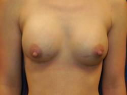 After Results for Breast Augmentation