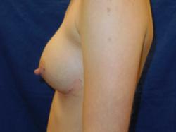 After Results for Breast Augmentation