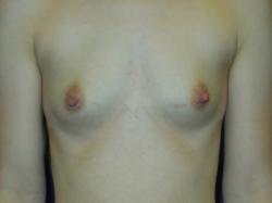 Before Results for Breast Augmentation