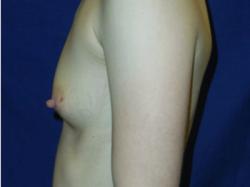 Before Results for Breast Augmentation