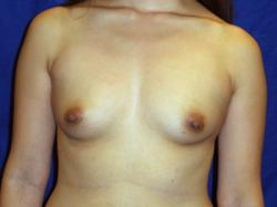 Before Results for Breast Augmentation