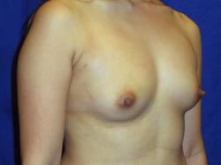 Before Results for Breast Augmentation