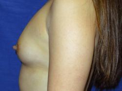 Before Results for Breast Augmentation