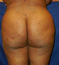 After Results for Brazilian Butt Lift / Gluteal Augmentation