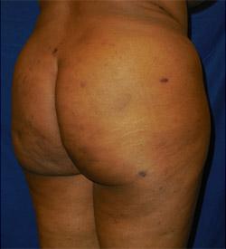 After Results for Gluteal Augmentation