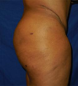 After Results for Gluteal Augmentation