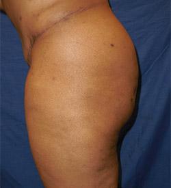 After Results for Gluteal Augmentation