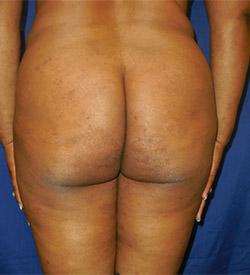 Before Results for Brazilian Butt Lift / Gluteal Augmentation