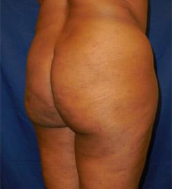 Before Results for Gluteal Augmentation