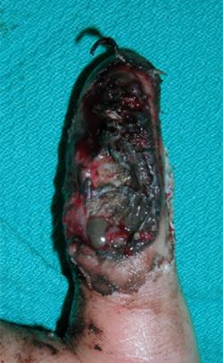 Before Results for Wound Care
