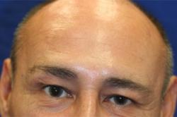 After Results for Neuromodulators (Botox / Dysport)