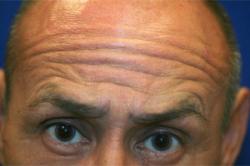 Before Results for Neuromodulators (Botox / Dysport)