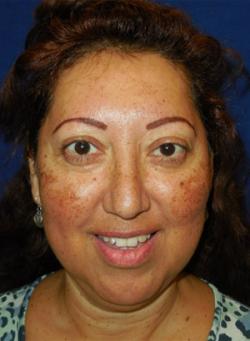 After Results for Neuromodulators (Botox / Dysport)