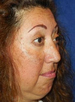 Before Results for Botox