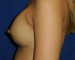 After Results for Breast Augmentation