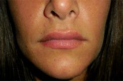 After Results for Lip Augmentation