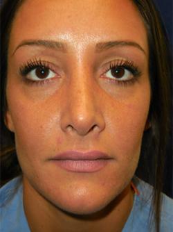 Before Results for Tissue Fillers, Lip Augmentation