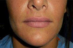 Before Results for Tissue Fillers, Lip Augmentation