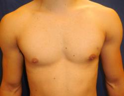 After Results for Gynecomastia